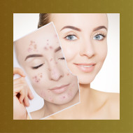 Face - IMPURE SKIN AND ACNE